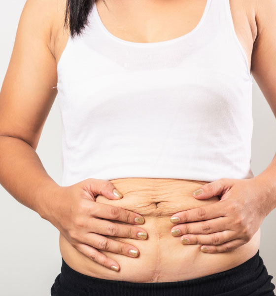 ابدومینوپلاستی شکم مرکز جراحی درمان جو