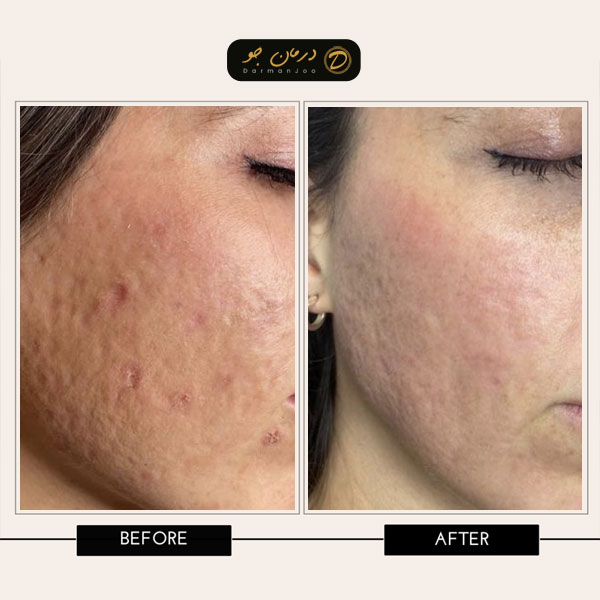 هزینه لیزر فرکشنال قبل و بعد هزینه لیزر فرکشنال قبل و بعد