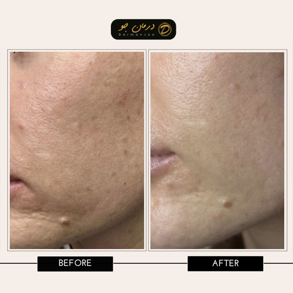هزینه لیزر فرکشنال قبل و بعد2 هزینه لیزر فرکشنال قبل و بعد2