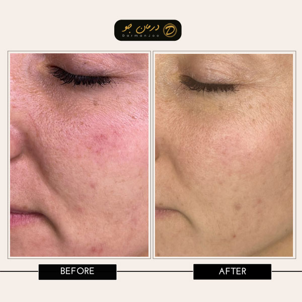 هزینه لیزر فرکشنال قبل و بعد3 هزینه لیزر فرکشنال قبل و بعد3