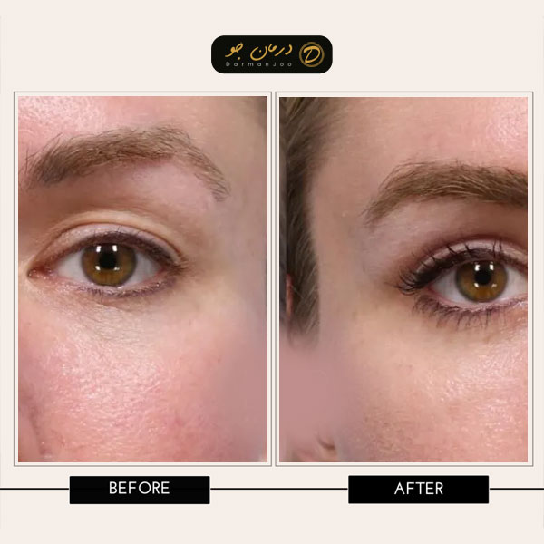 بلفاروپلاستی با لیزر قبل و بعد 1 بلفاروپلاستی با لیزر قبل و بعد 1