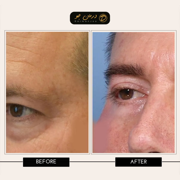بلفاروپلاستی با لیزر قبل و بعد 2 بلفاروپلاستی با لیزر قبل و بعد 2