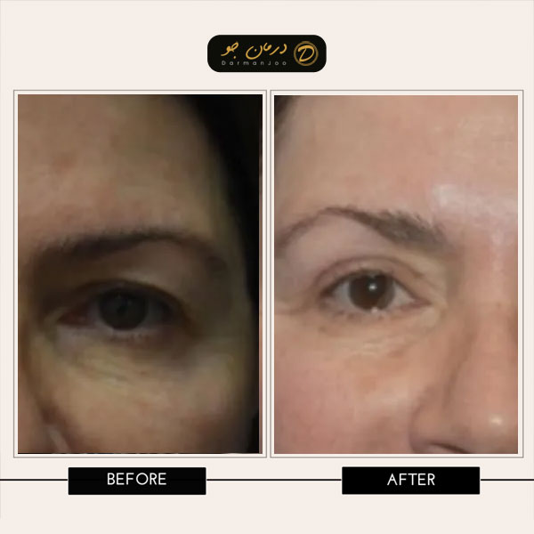 بلفاروپلاستی با لیزر قبل و بعد 3 بلفاروپلاستی با لیزر قبل و بعد 3