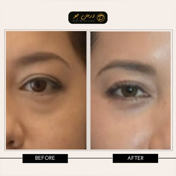 بلفاروپلاستی با لیزر قبل و بعد 4 بلفاروپلاستی با لیزر قبل و بعد 4