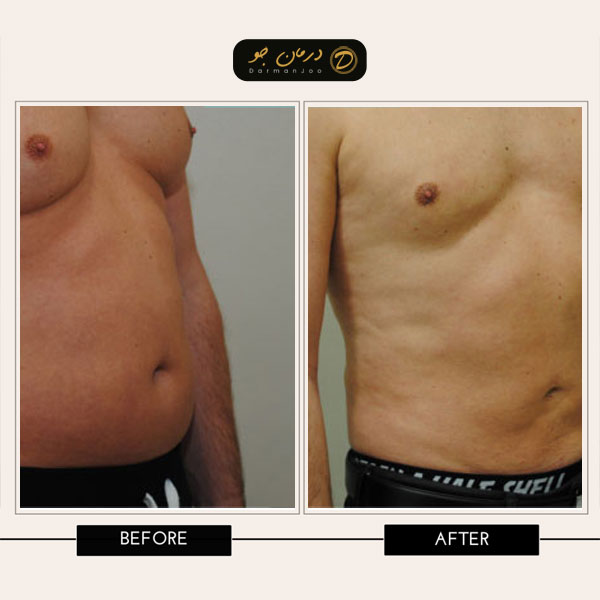 قبل و بعد لیپوساکشن شکم و پهلو 2