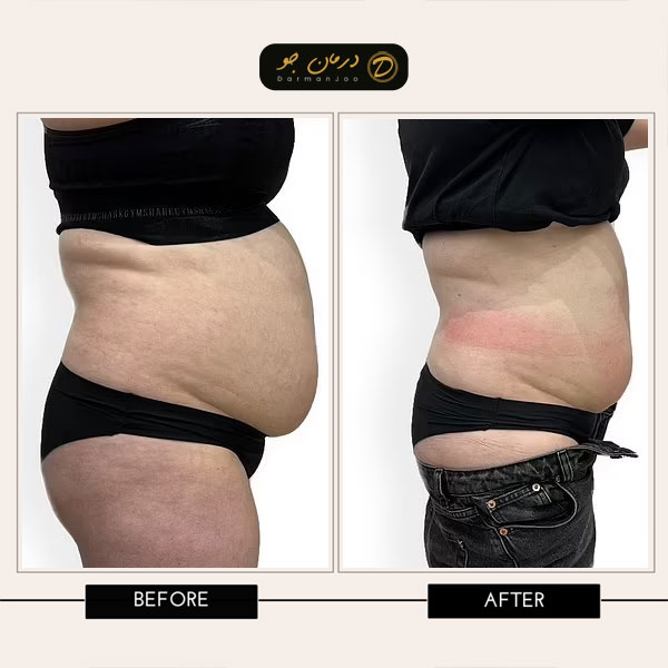 جراحی زیبایی شکم