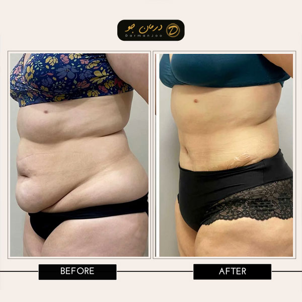 جراحی زیبایی شکم