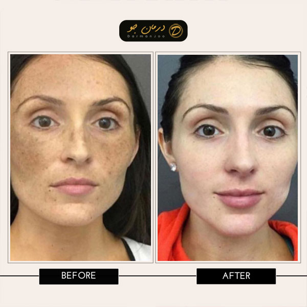 لیزر روشن سازی قبل و بعد 2