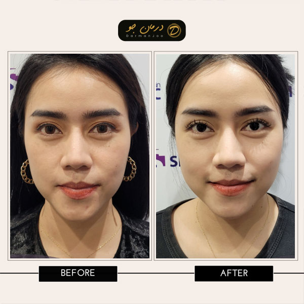 لیزر روشن سازی قبل و بعد