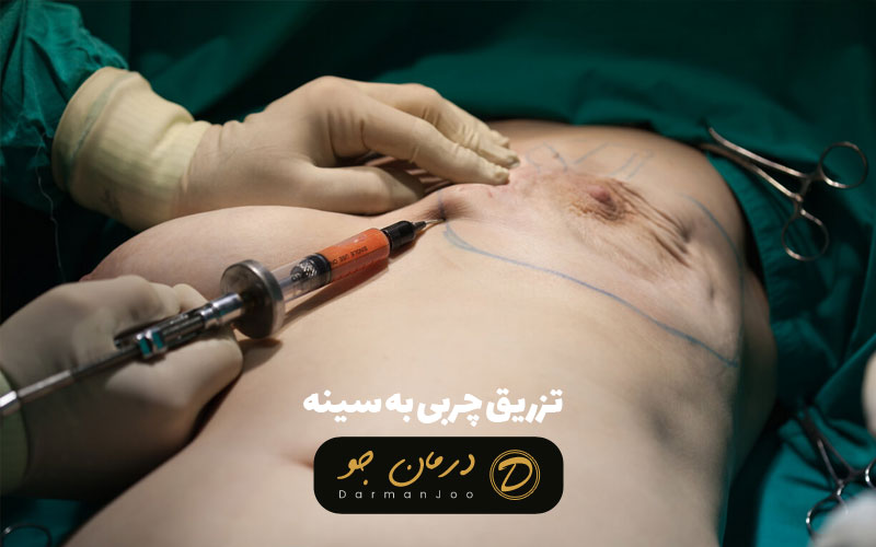 تزریق چربی به سینه