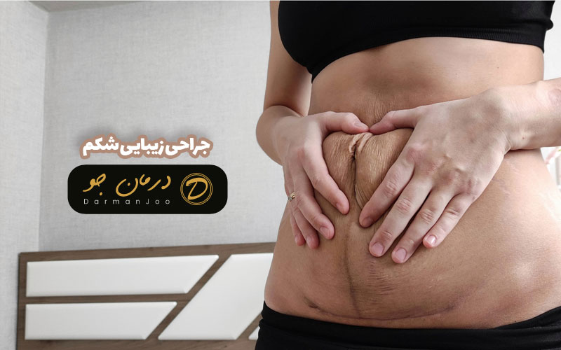 جراحی زیبایی شکم