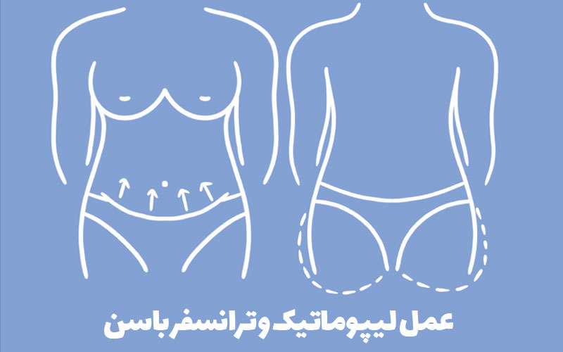 عمل لیپوماتیک و ترانسفر باسن