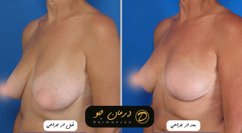 جراحی زیبایی سینه