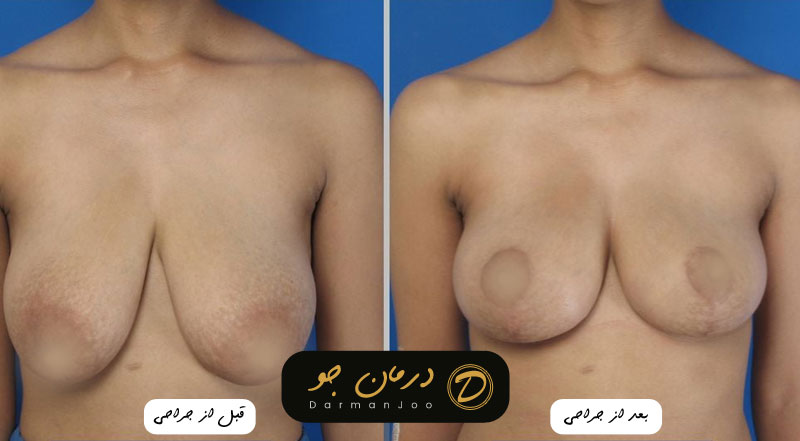 عکس پروتز سینه 3