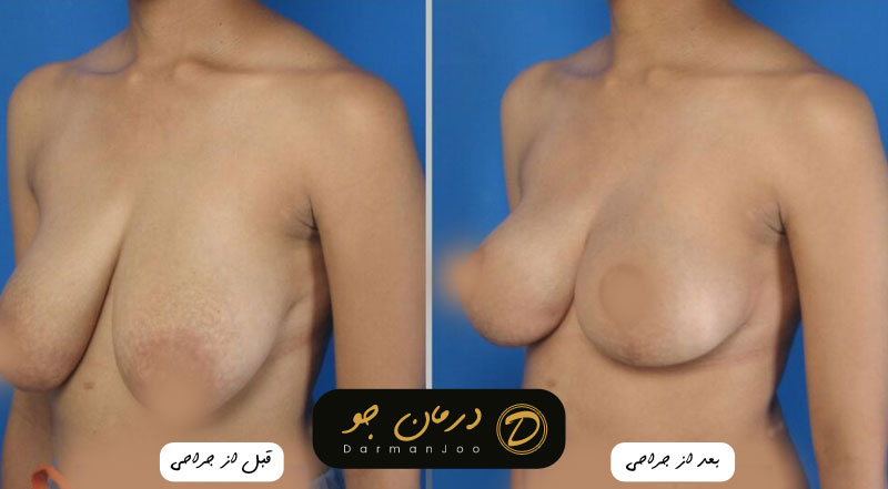 عکس پروتز سینه 4