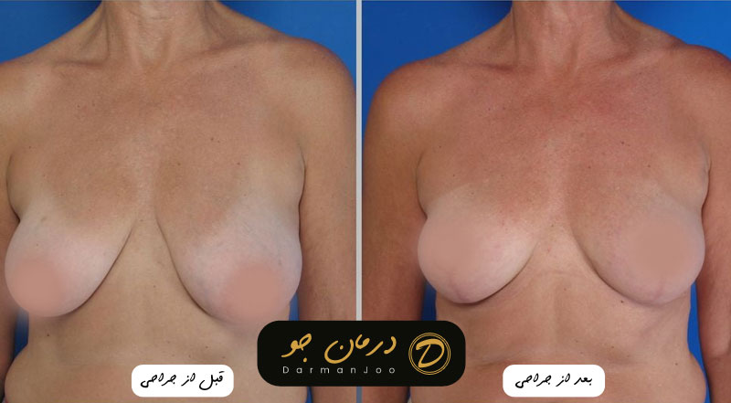 جراحی زیبایی سینه