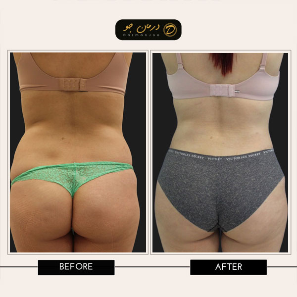 قبل و بعد عمل لیپوماتیک و ترانسفر باسن 2