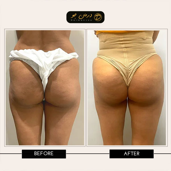 قبل و بعد عمل لیپوماتیک و ترانسفر باسن 3