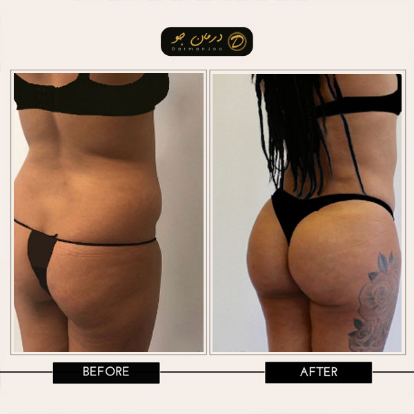 قبل و بعد عمل لیپوماتیک و ترانسفر باسن 4