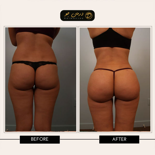 قبل و بعد عمل لیپوماتیک و ترانسفر باسن