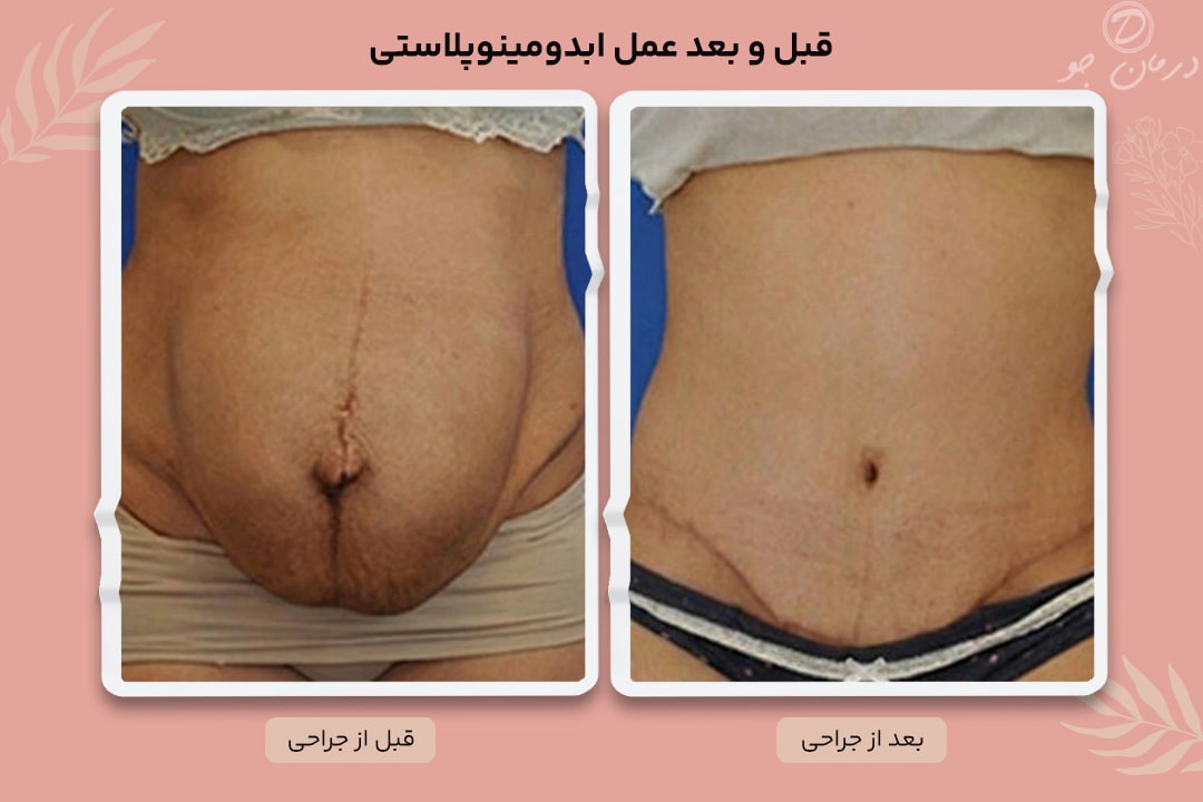 عکس بل و بعد عمل ابدومینوپلاستی
