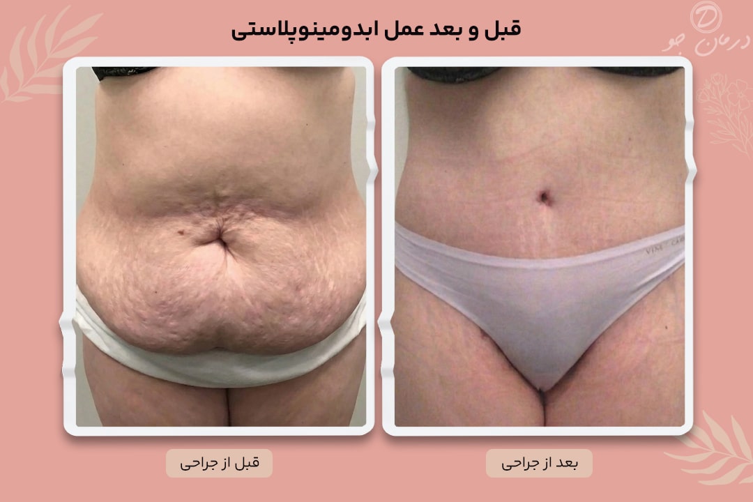 عکس قبل و بعد ابدومینوپلاستی