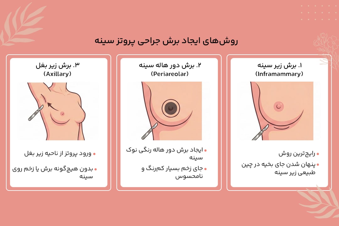 جراحی پروتز سینه