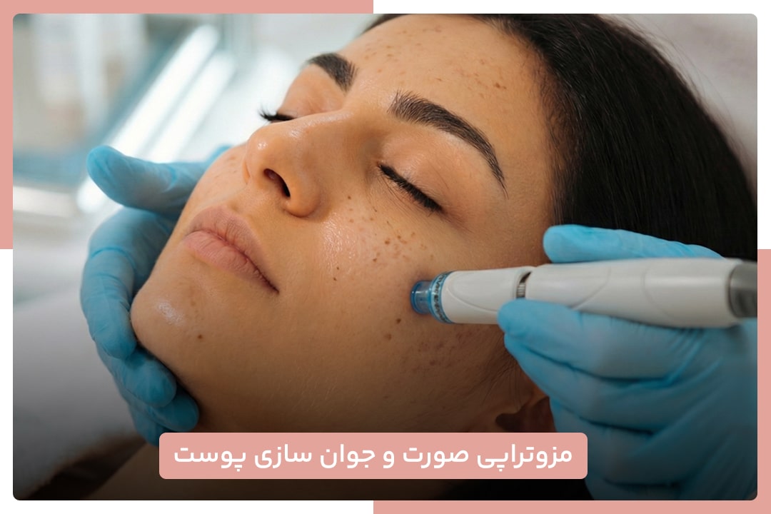 مزوتراپی صورت