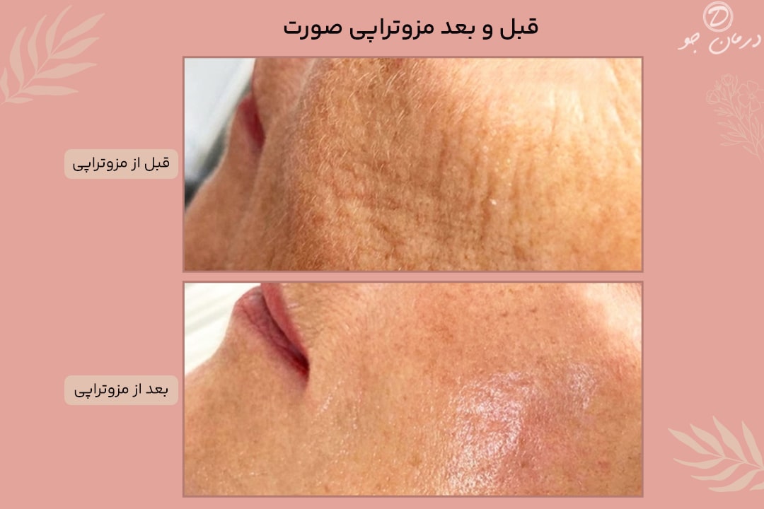 قبل و بعد مزوتراپی صورت