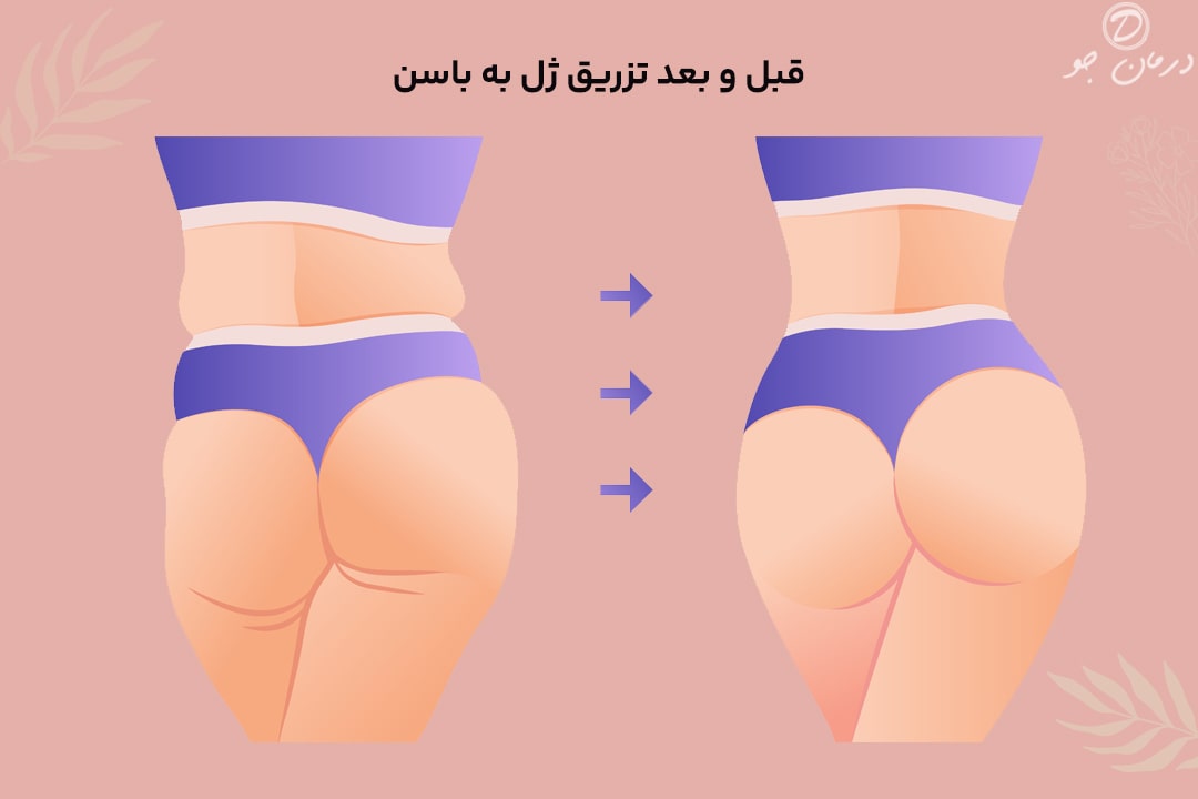 عکس قبل و بعد تزریق ژل به باسن
