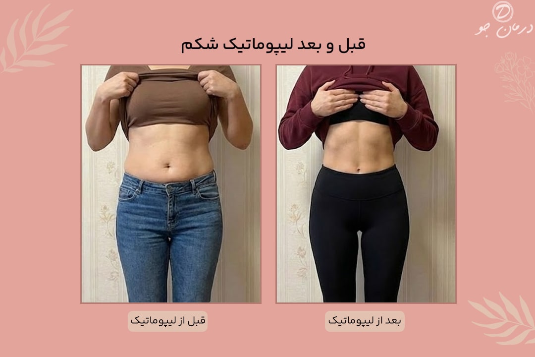 قبل و بعد لیپوماتیک