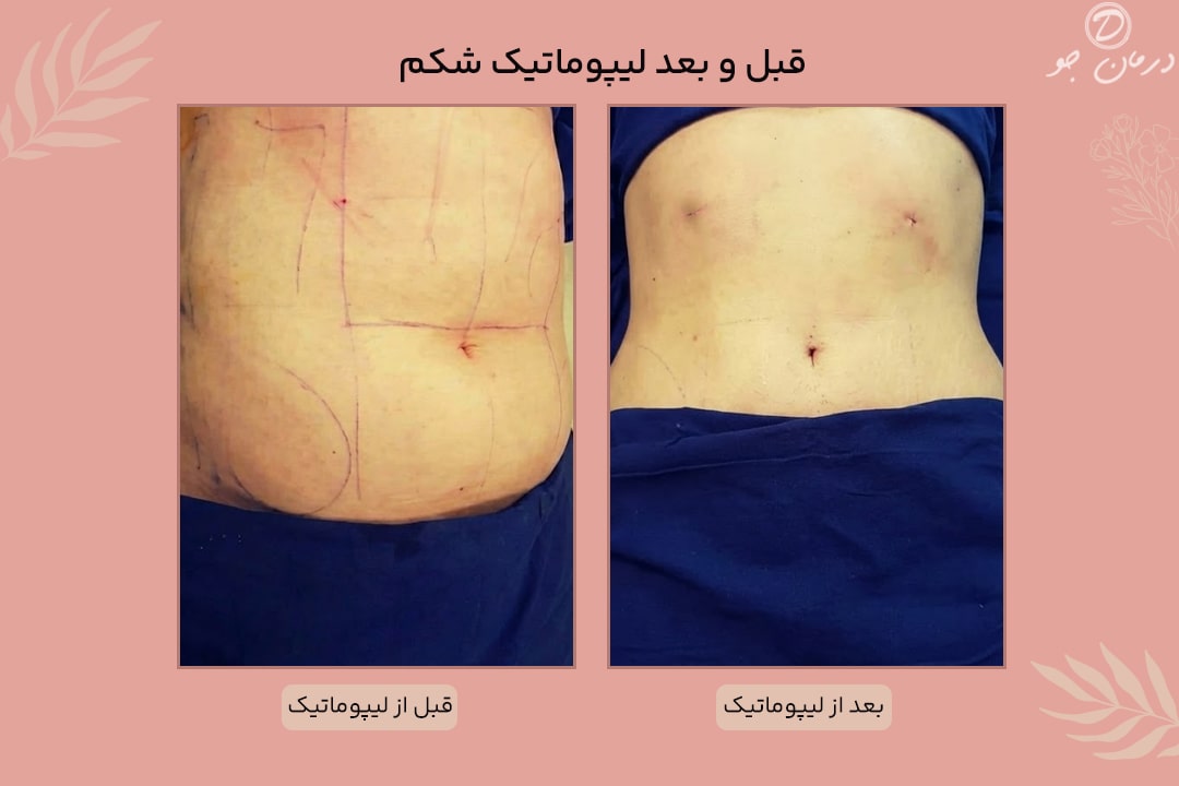 عکس قبل و بعد لیپوماتیک