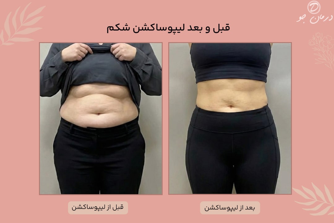 عکس قبل و بعد لیپوساکشن