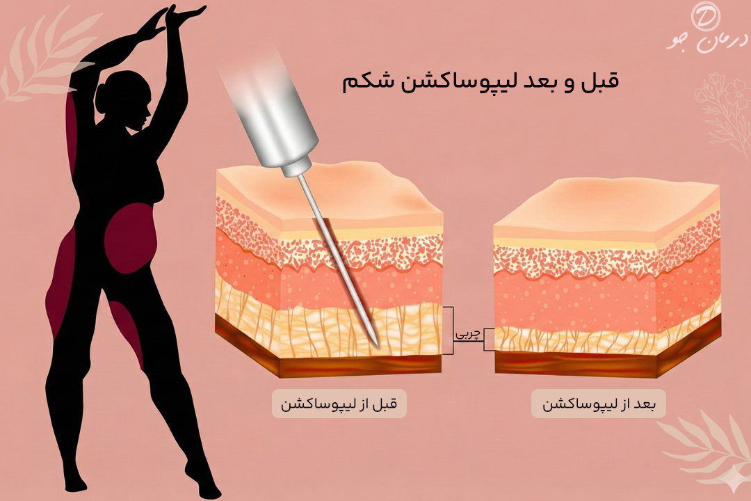 قبل و بعد لیپوساکشن شکم