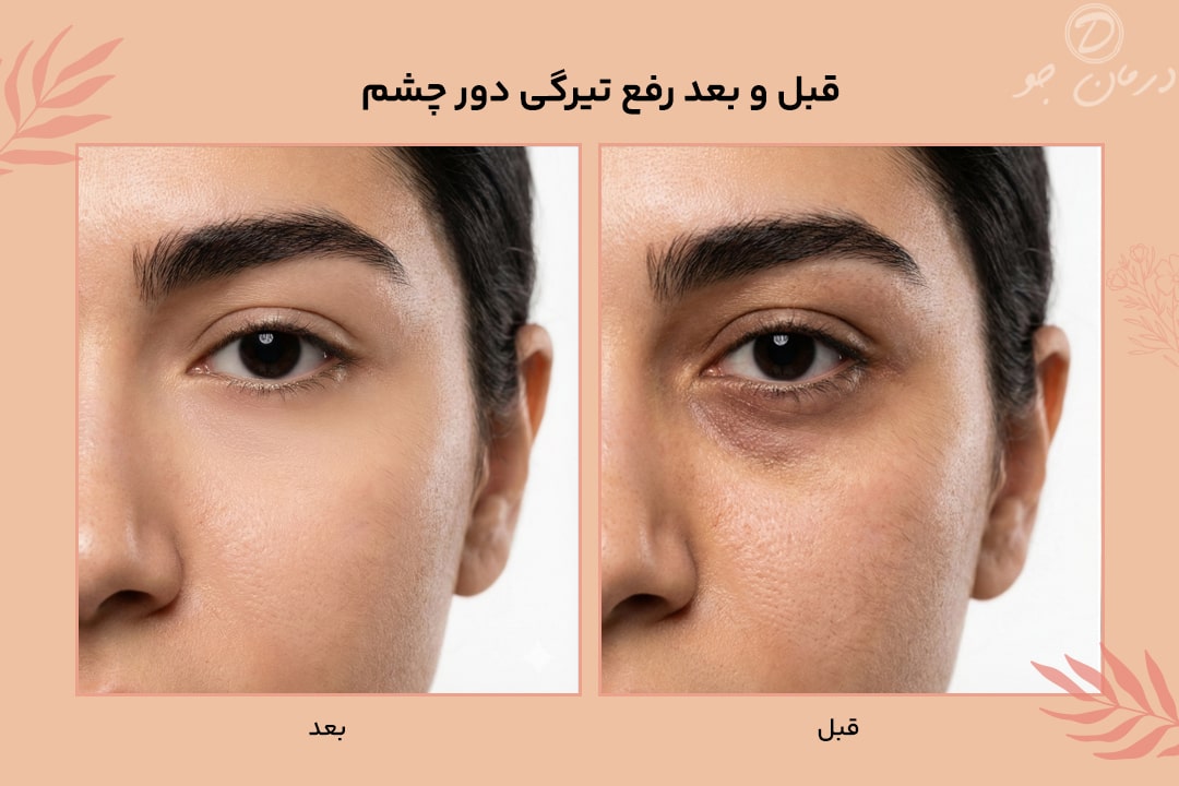 عکس قبل و بعد رفع تیرگی دور چشم