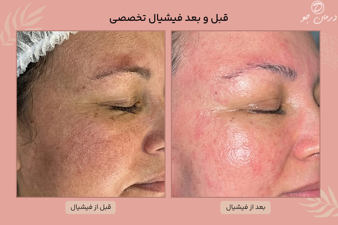 عکس قبل و بعد فیشیال