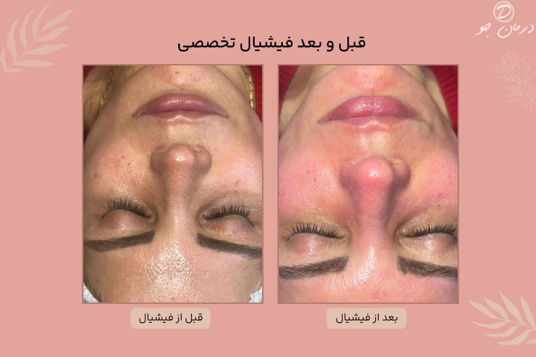 عکس قبل و بعد فیشیال