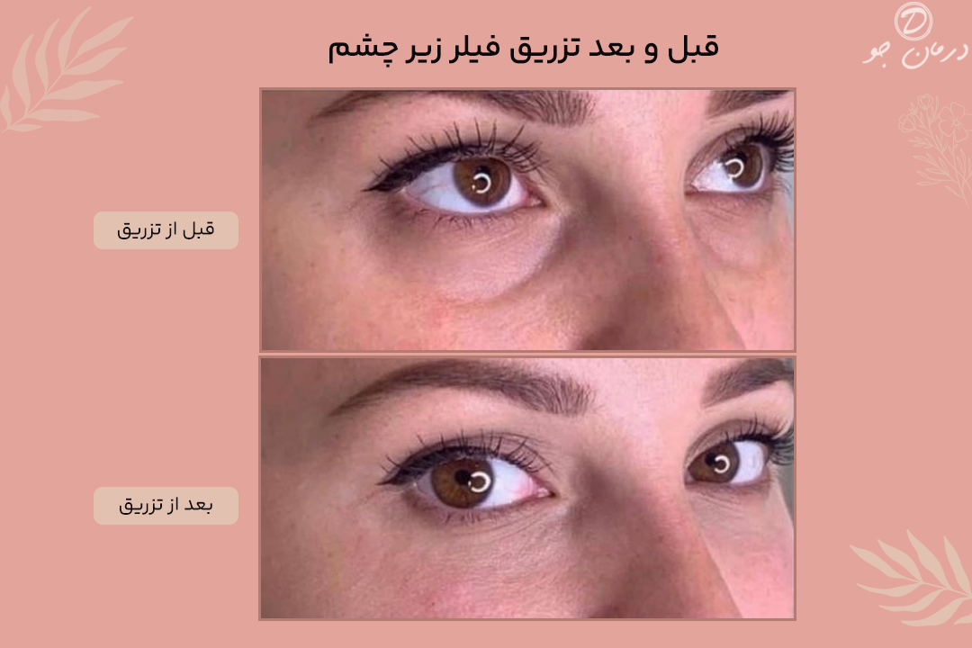 عکس قبل و بعد تزریق فیلر زیر چشم