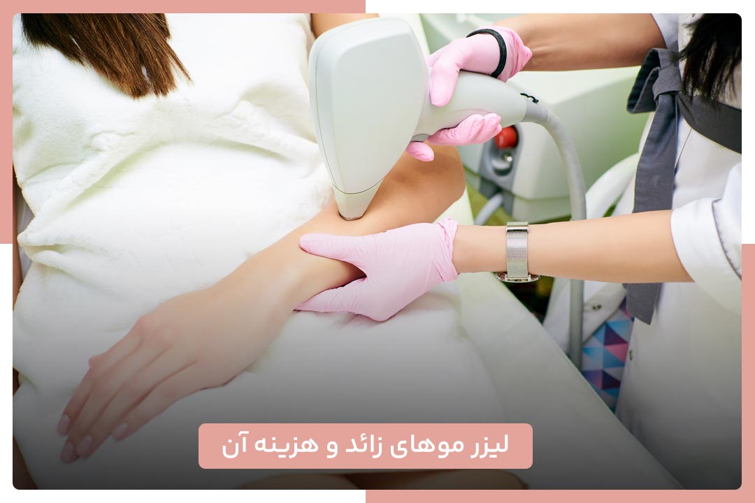 لیزر موهای زائد