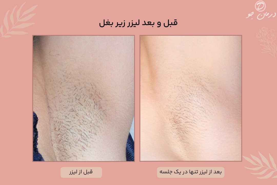 عکس قبل و بعد لیزر مو زائد