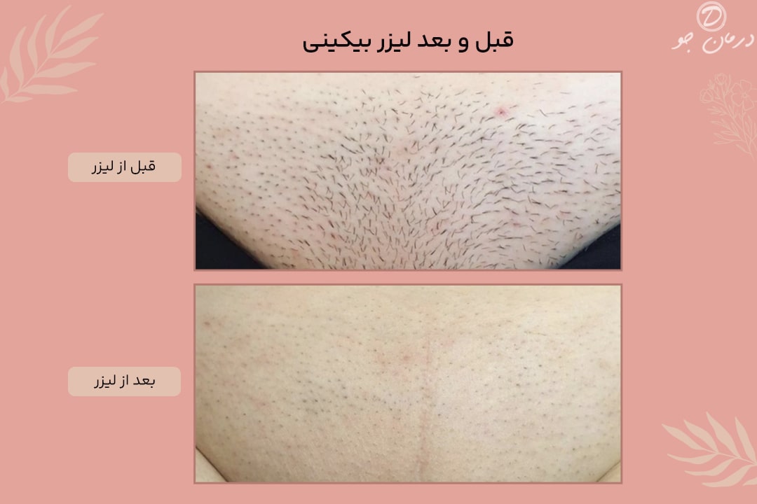 لیزر قبل و بعد بیکینی